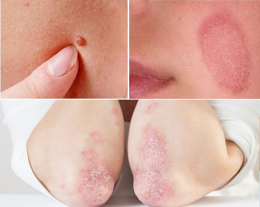 Keramiin on efektiivne papilloomide, seente, psoriaasi vastu