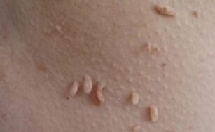 Filiformsed papilloomid
