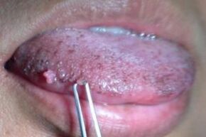 Papilloomid keelel